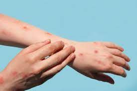 Experts give monkeypox virus variants new names 11 Monkey