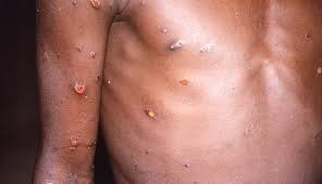 Another suspected case of Monkeypox discovered in Osun 1