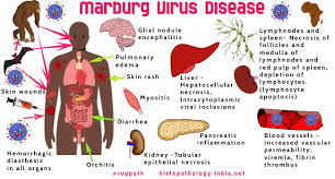 University of Abuja Teaching Hospital warns of Marbug disease outbreak 1 images 44