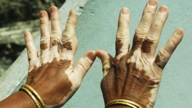 Nigerians with vitiligo face stigma – a skin doctor calls for better support, By Umar Abdullahi 4 IMG 20221124 WA0006