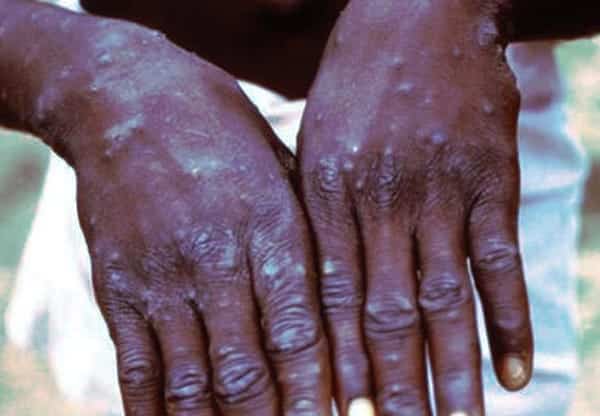 WHO declares Mpox public health emergency of international concern 1 WhatsApp Image 2024 08 15 at 8.40.31 AM