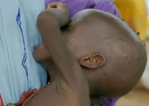 Over 600 malnourished Nigerian children died in 6 months- MSF 1 Malnutrition in northeast Nigeria Unicef2